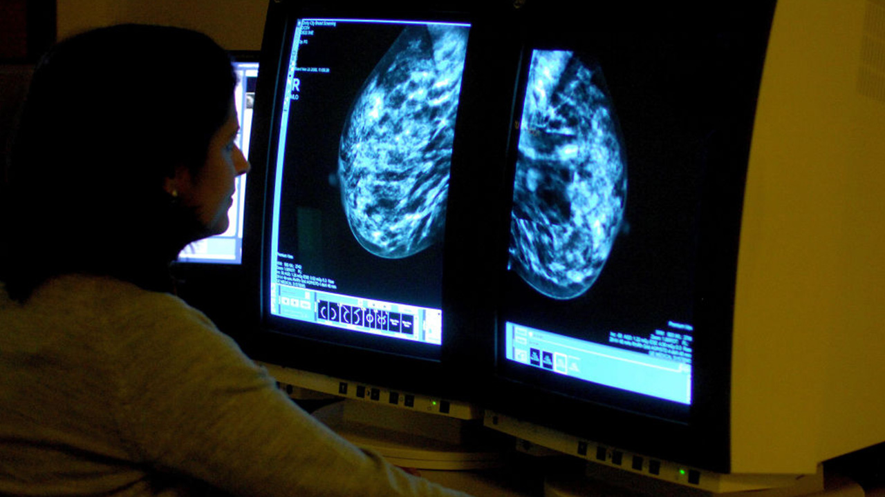 Targeted drug shrinks tumors in 3 out of 4 patients with advanced breast cancer — Tarpon Springs Schools news